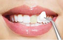 Pinzette hält Zahnveneer vor Zähne